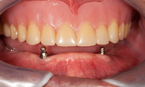 UMKC Dental Faculty Practice Dental Implant Dentures Example 3