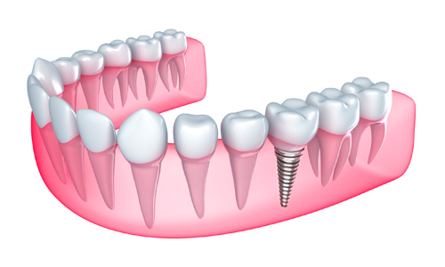 UMKC Dental Faculty Practice Dental Implant Example 3