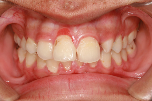 UMKC Dental Faculty Practice Gum Disease Anne